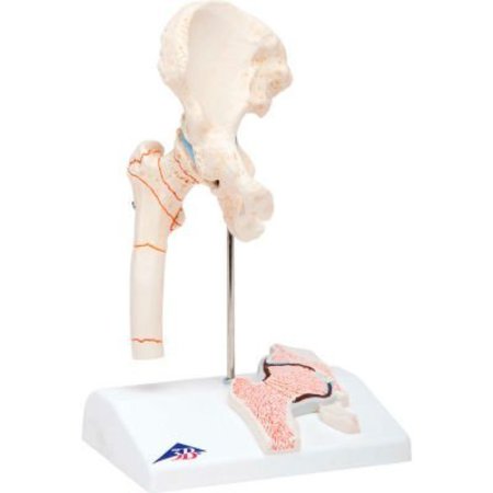 FABRICATION ENTERPRISES 3B® Anatomical Model - Femoral Fracture and Hip Osteoarthritis 978091